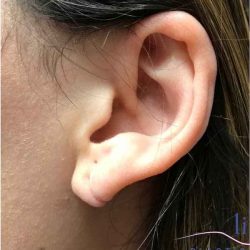 Ear Surgery Before & After Patient #1708
