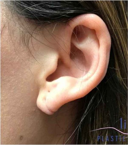 Ear Surgery Before & After Patient #1708