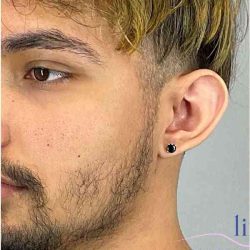 Ear Surgery Before & After Patient #1715