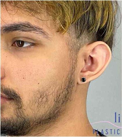 Ear Surgery Before & After Patient #1715