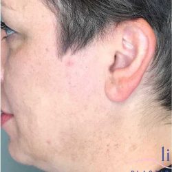 Ear Surgery Before & After Patient #1724