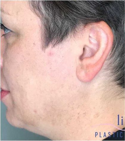 Ear Surgery Before & After Patient #1724