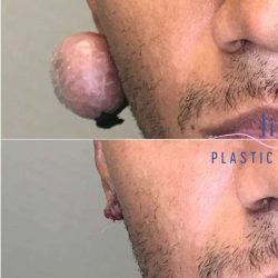 Ear Surgery Before & After Patient #1731