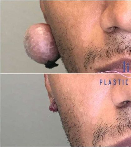 Ear Surgery Before & After Patient #1731