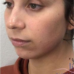 Chin Augmentation Before & After Patient #1738