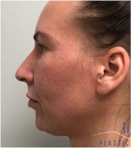 Chin Augmentation Before & After Patient #1747