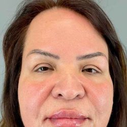 Eyelid Surgery Before & After Patient #1754