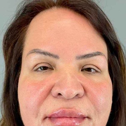 Eyelid Surgery Before & After Patient #1754