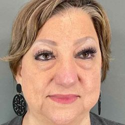 Eyelid Surgery Before & After Patient #1761