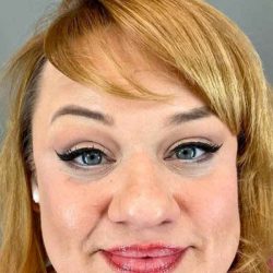 Eyelid Surgery Before & After Patient #1775