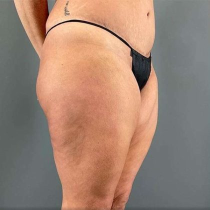 Thigh Lift Before & After Patient #233
