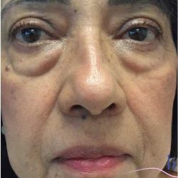 Eyelid Surgery Before & After Patient #1789