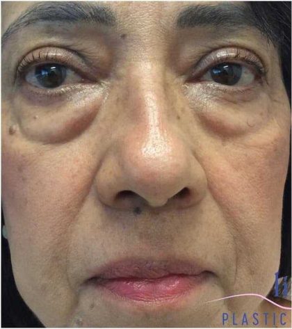 Eyelid Surgery Before & After Patient #1789
