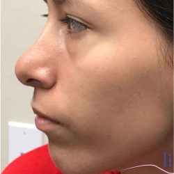 Rhinoplasty Before & After Patient #1796