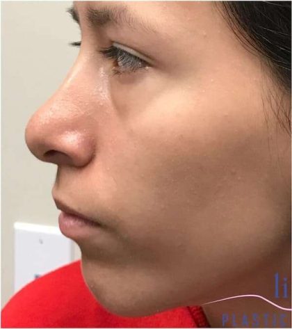 Rhinoplasty Before & After Patient #1796