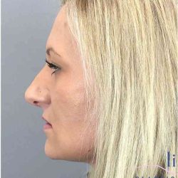 Rhinoplasty Before & After Patient #1807
