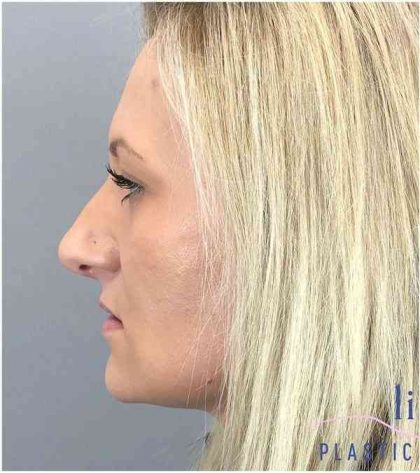 Rhinoplasty Before & After Patient #1807