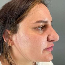 Rhinoplasty Before & After Patient #1818