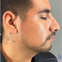Rhinoplasty Before & After Patient #1825