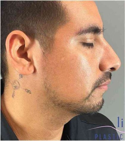 Rhinoplasty Before & After Patient #1825