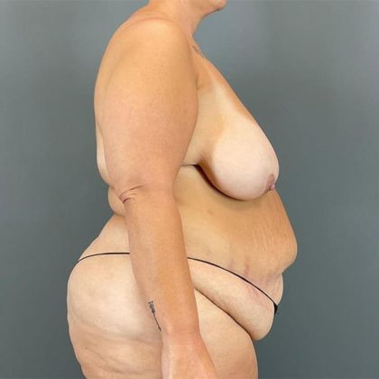 Breast Reduction Before & After Patient #1826