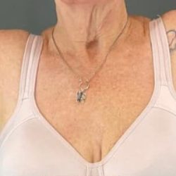 Arm Lift Before & After Patient #219