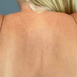 Arm Lift Before & After Patient #198