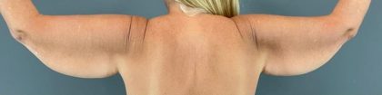 Arm Lift Before & After Patient #198