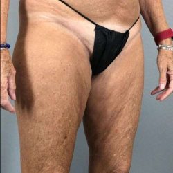 Thigh Lift Before & After Patient #240