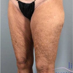 Thigh Lift Before & After Patient #247