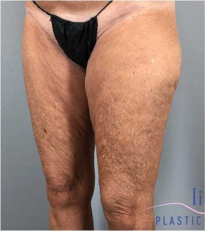 Thigh Lift Before & After Patient #247