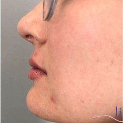 Injectables&Fillers Before & After Patient #130
