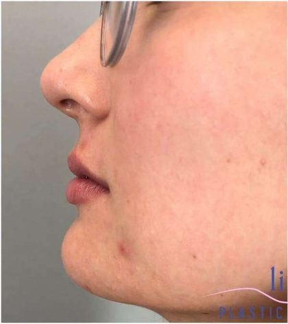 Injectables&Fillers Before & After Patient #130