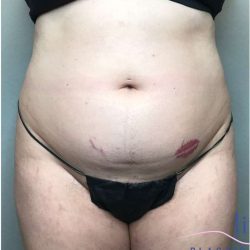 Bodytite Before & After Patient #258