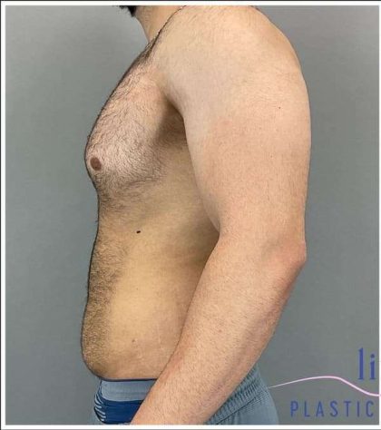 Bodytite Before & After Patient #280