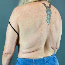Back Lift Before & After Patient #287