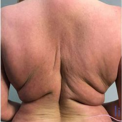 Back Lift Before & After Patient #292