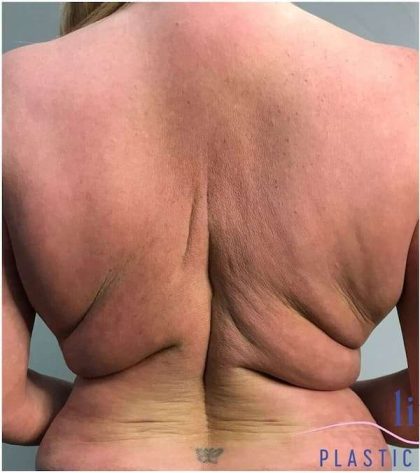 Back Lift Before & After Patient #292