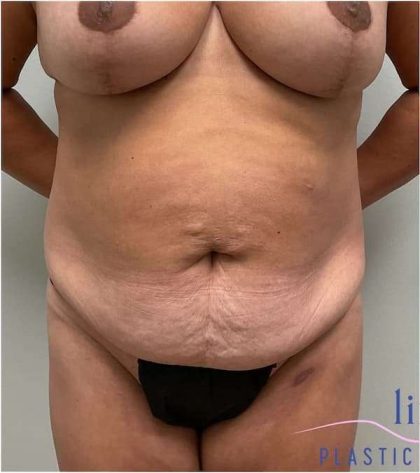 Tummy Tuck Before & After Patient #303