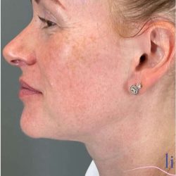 Injectables&Fillers Before & After Patient #118