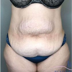Tummy Tuck Before & After Patient #314