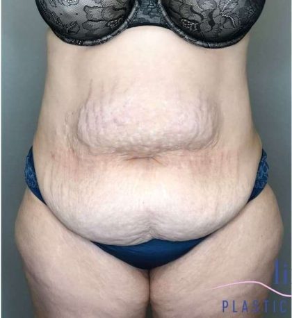 Tummy Tuck Before & After Patient #314