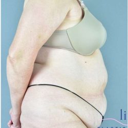 Tummy Tuck Before & After Patient #325