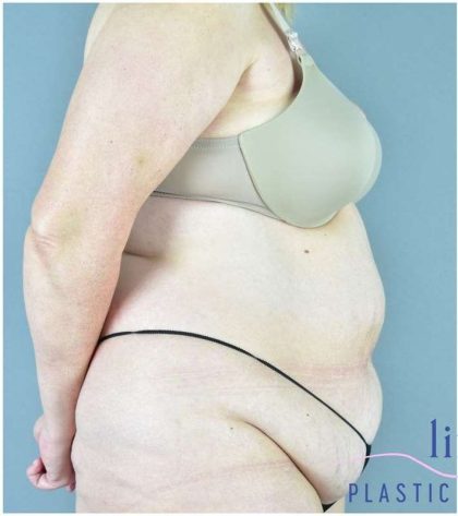 Tummy Tuck Before & After Patient #325