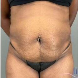 Tummy Tuck Before & After Patient #332