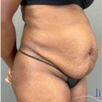 Tummy Tuck Before & After Patient #339