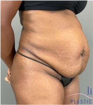 Tummy Tuck Before & After Patient #339