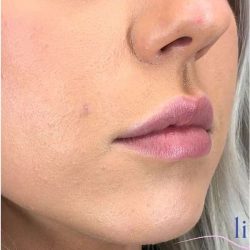 Injectables&Fillers Before & After Patient #135