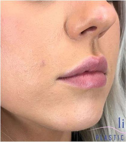 Injectables&Fillers Before & After Patient #135
