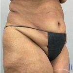 Tummy Tuck Before & After Patient #346